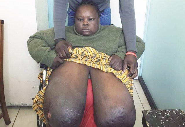 BULAWAYO breast cancer patient (36) dies after five donors come forward for US$10 000 for June 16 operation