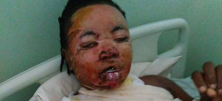 A SAKUBVA woman sustained serious facial and chest burns last Thursday after a vicious hot cooking oil attack by her husband
