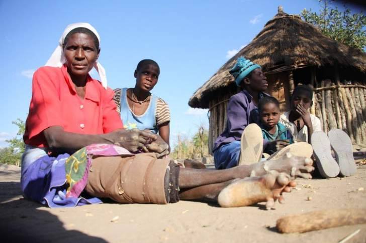 ‘A family in Inyanga suffers from a strange condition’