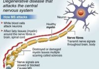 MULTIPLE SCLEROSIS (MS) TREATMENT BREAK THROUGH:There has been a major Medical break through after stem cells were used to treat Multiple Sclerosis (MS) .